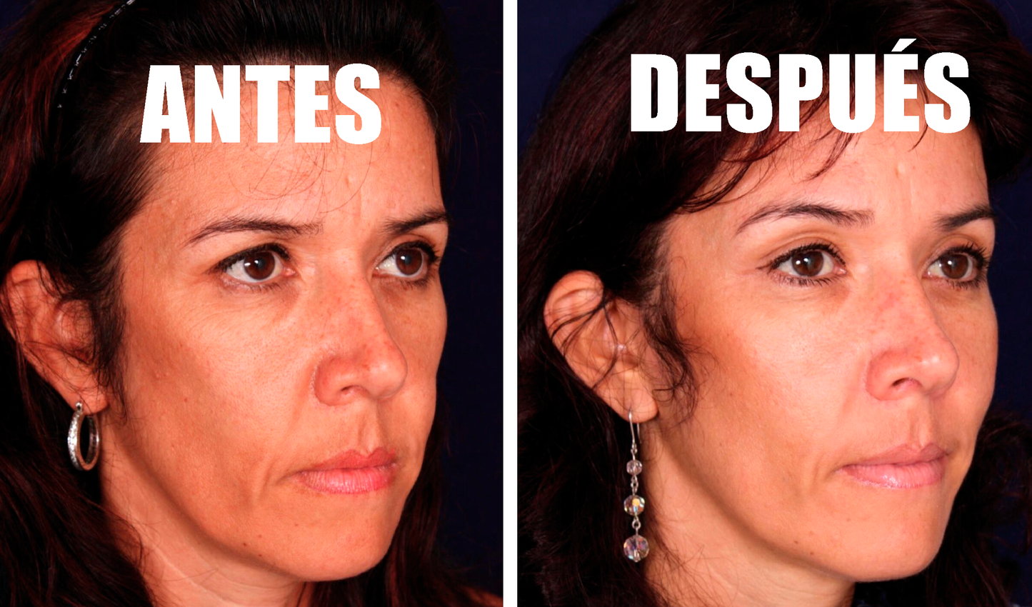 Luminis Pro: Piel radiante